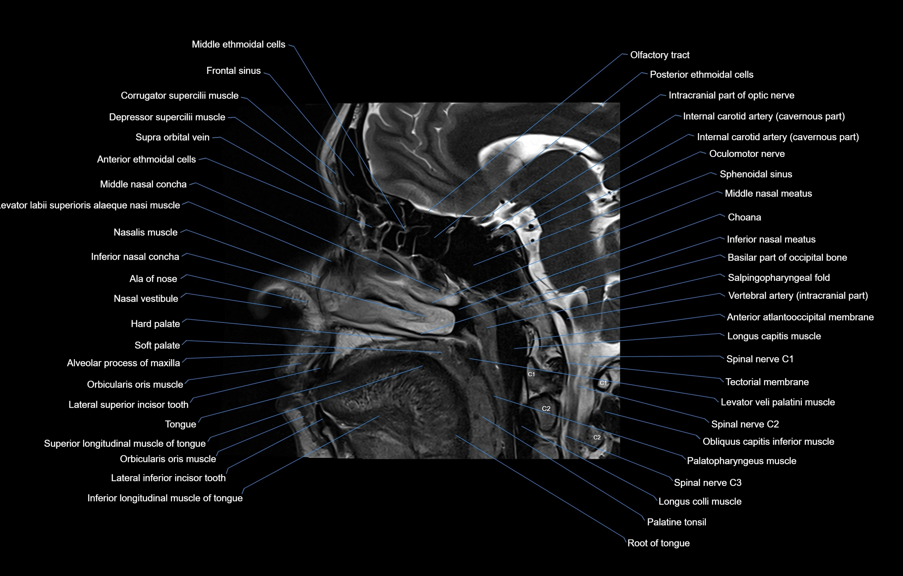 paranasal sinuses(PNS) MRI coronal  cross sectional anatomy 3T radiology  image-img-00001-00006.webp